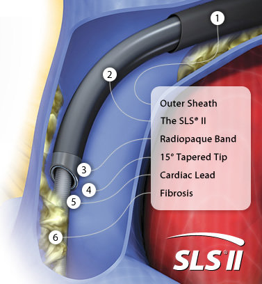 SLS II Excimer Laser Sheath ? Spectranetics